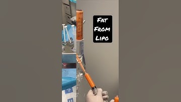 Best filler for the Face | Fat transfer After Liposuction