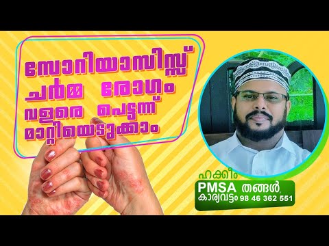 സോറിയാസിസ്സ് | ചർമ്മ രോഗം വളരെ പെട്ടന്ന് മാറ്റിയെടുക്കാം | soriyas disease|Home Treatment |Ayurvedha