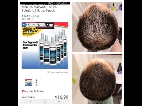 3 Journey & Review Using Kirkland's Minoxidil 5% Stuff Works!!!"" - YouTube