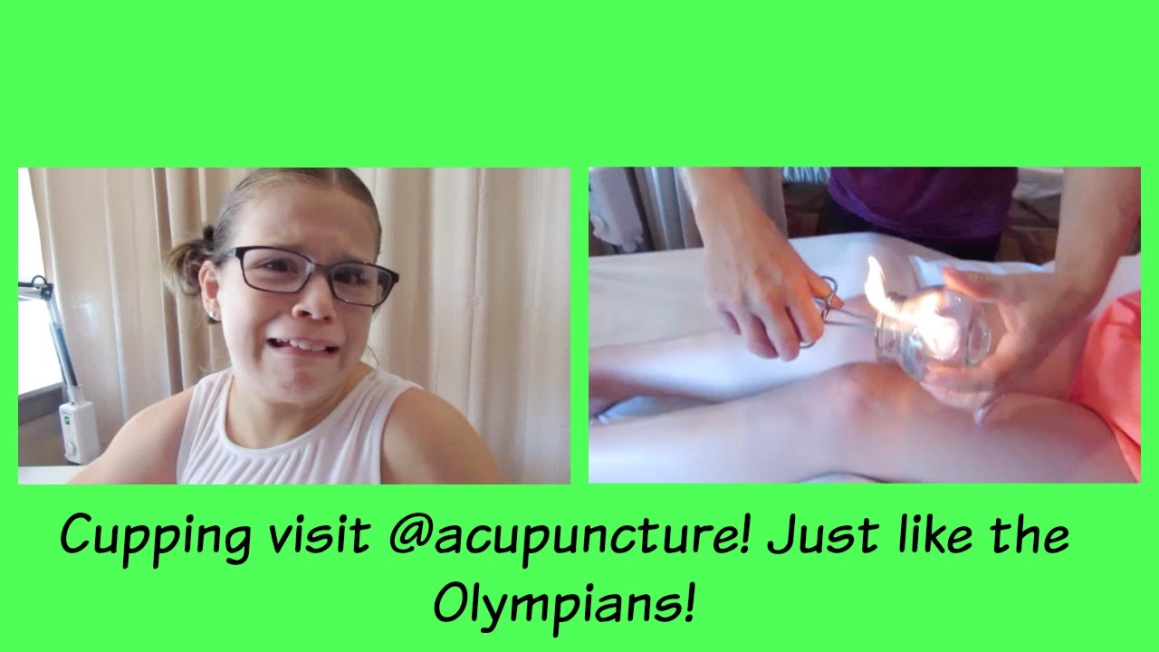 Cupping acupuncture! Just like the Olympians! Daily Vlog 8.23 YouTube