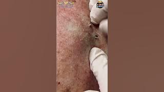 2 Giant Comedones 🌋 expressed at Las Vegas Dermatology