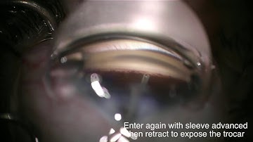 iStent Inject teaching video - Dr. Paul Singh, MD