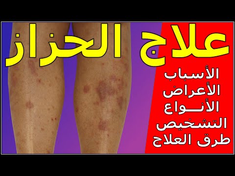 الحزاز الاسباب والأعراض والأنواع والتشخيص والعلاج والنصائح Lichen Planus #سامح_البكري