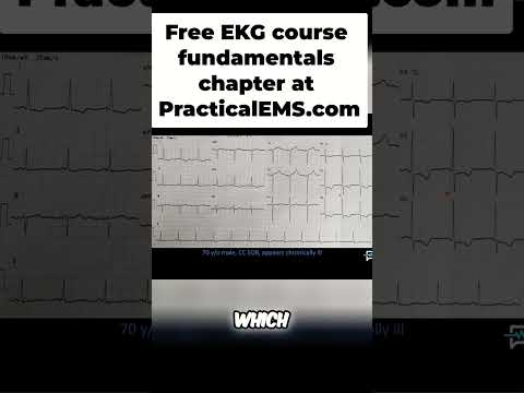 Understanding LVH Diagnosis And Strain Patterns Explained