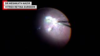 Induction of PVD in retinal detachment case