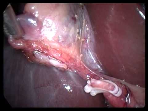 Lap  Cholecystectomy Unedited 294 Simple Chronic Cholecystitis With Cholesterosis