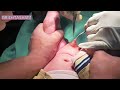 Circumcision By Plastibell Technique Circumcision By Plastibell Technique