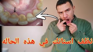 متي يجب ان تزور طبيب الاسنان لتنظيف اسنانك؟