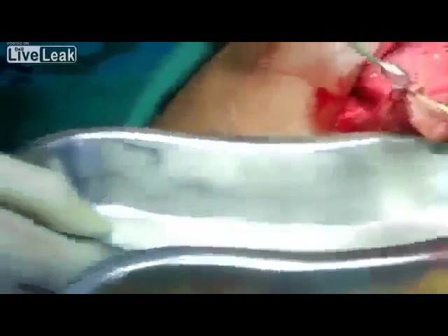 Эхинококкоз печени. Паразиты в печени!