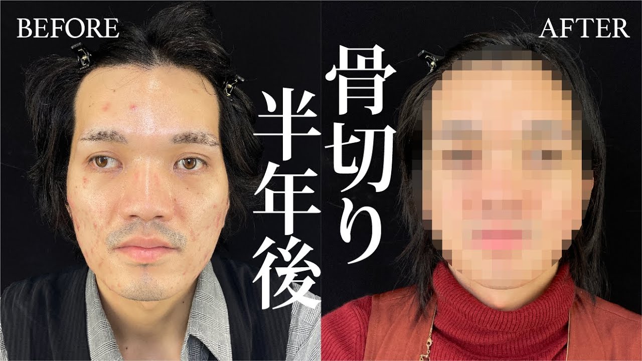 【美容整形版 令和の虎】Xジェンダーとして生きる、決意の手術に密着