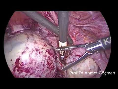 Dermoid cyst in malpositioned ovary