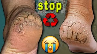 👣 Pedicure STEP BY STEP. Deep CRACKS! 😱 DRY HEEL Get rid of FOREVER. Pedicure at home. DIY Pedicure