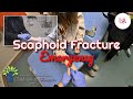 Scaphoid Bone Fracture Emergency