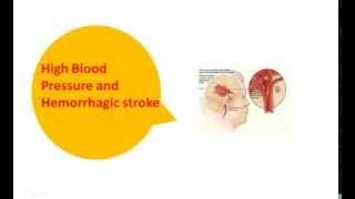 How High Blood Pressure Causes Strokes