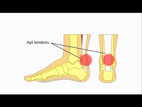 Aşil tendonu nedir? - Prof. Dr. Hakan Özsoy (Ortopedi ve Travmatoloji Uz.)