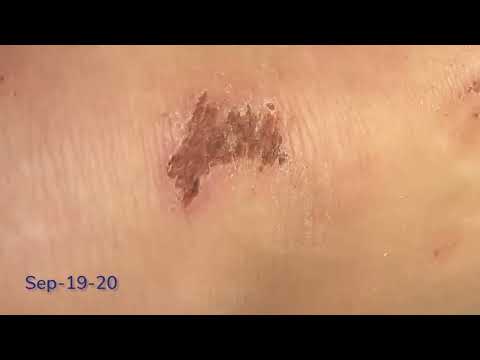 6.6 Lesson 8 Knee Scrape Timelapse - Audio Described