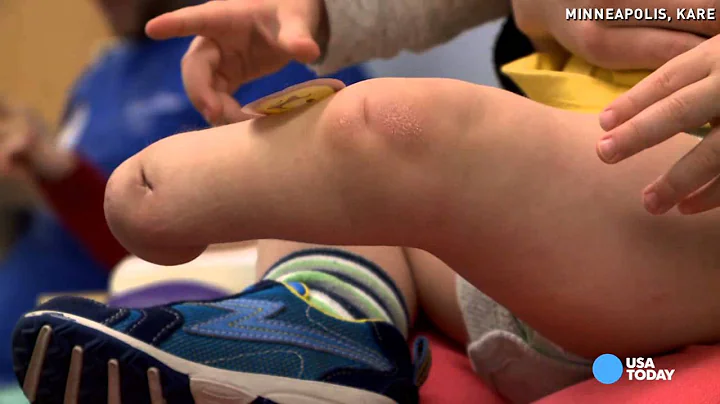 Toddler amputee zooms by parents in new prosthetic