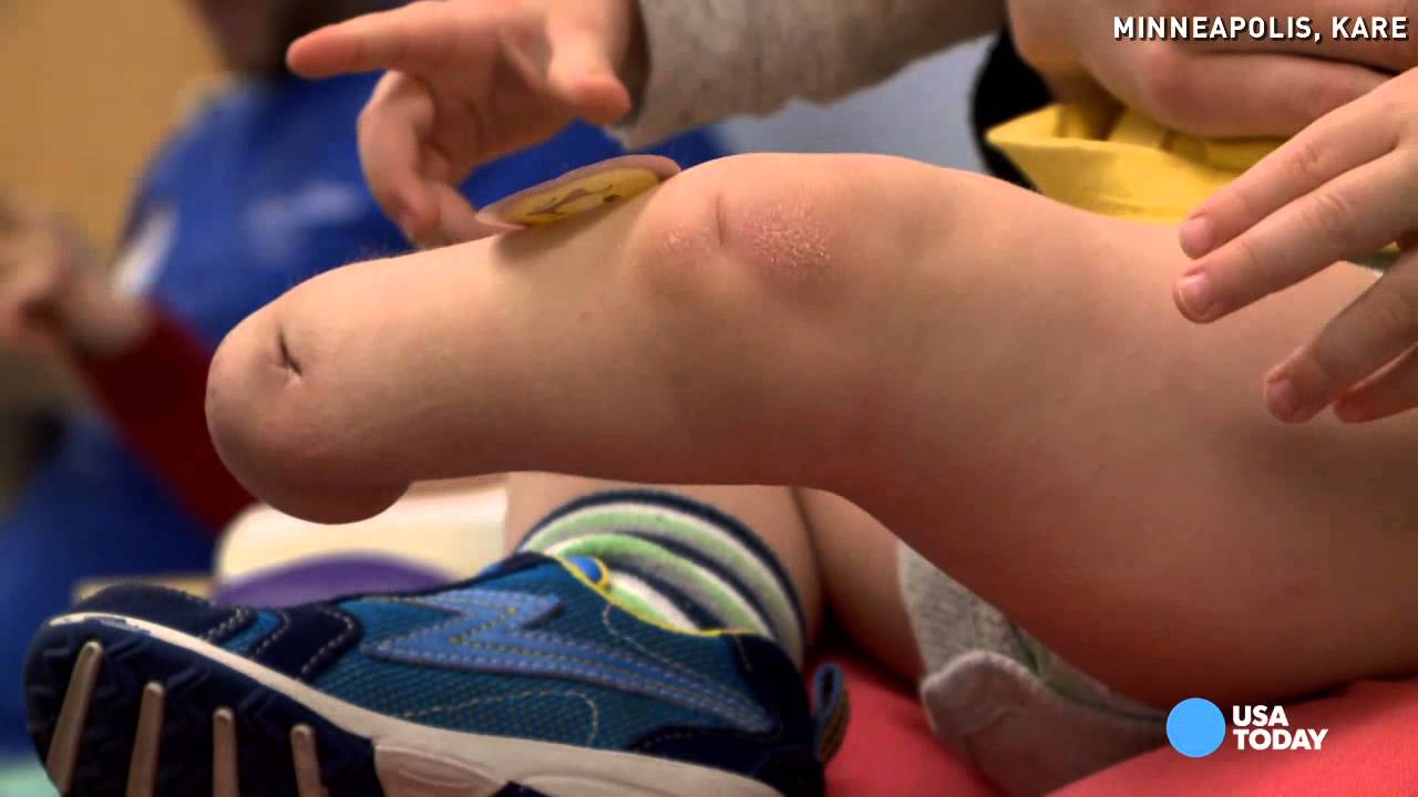 Toddler amputee zooms by parents in new prosthetic