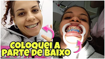 Como acabar com a dor de aparelho?