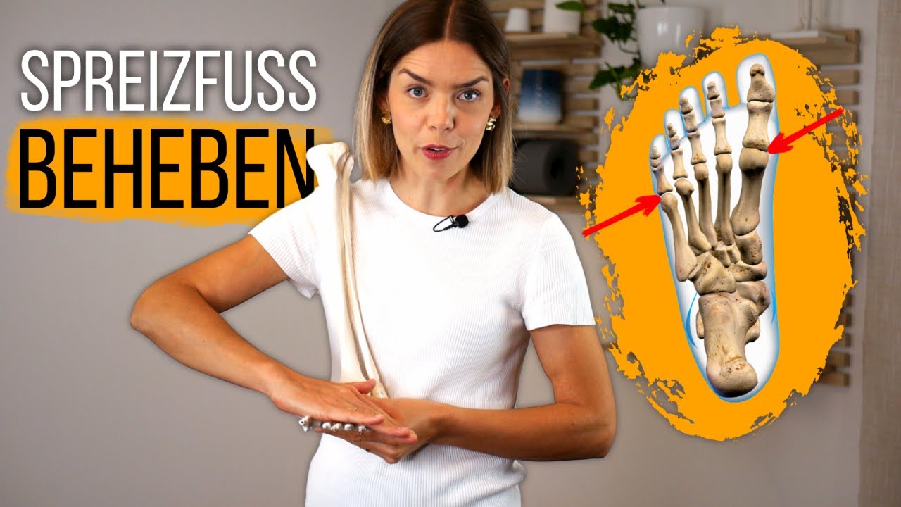 SPREIZFUß - alles was du wissen musst und wie du ihn LOSWERDEN kannst