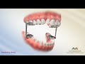 Orthodontic treatment for overjet overbite  advancesync appliance