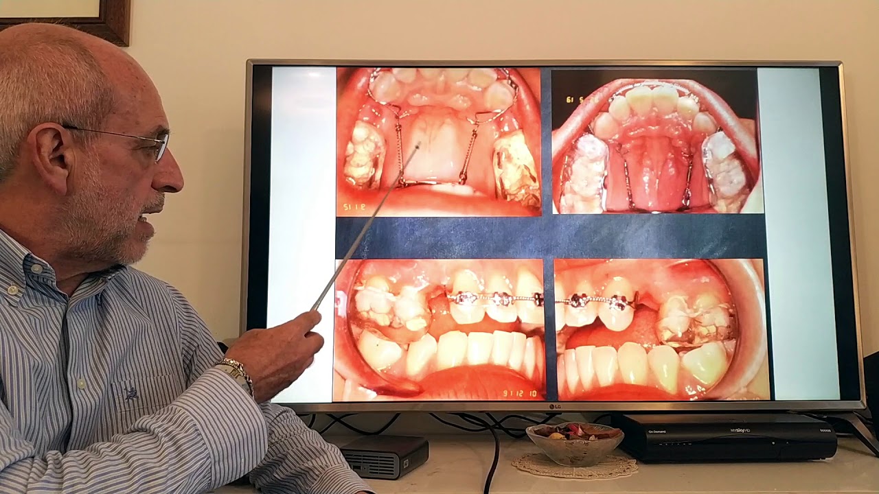 Le Rivoluzioni scheletrica & palatale