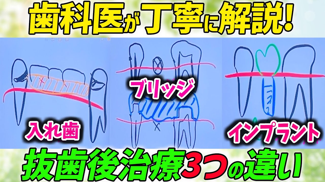 【必見】インプラントvs入れ歯vsブリッジ対決！メリット、デメリットを歯医者が徹底解説！歯を失う前にこれを見て！