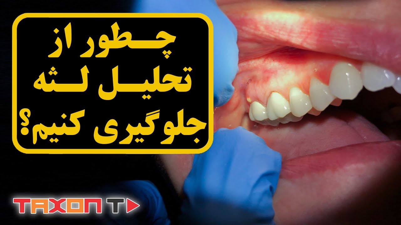 چطور از تحلیل لثه جلوگیری کنیم؟