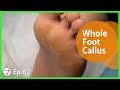 TOP MEDICAL PEDICURE Ep.62 - Whole Foot Callus Removed At Once