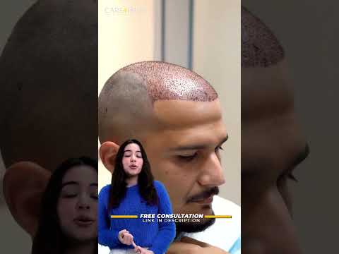 Vídeo: 3 maneres de cuidar un trasplantament de cabell