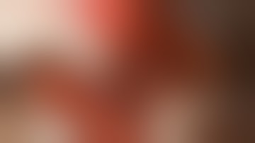 Open Ureterocalycostomy