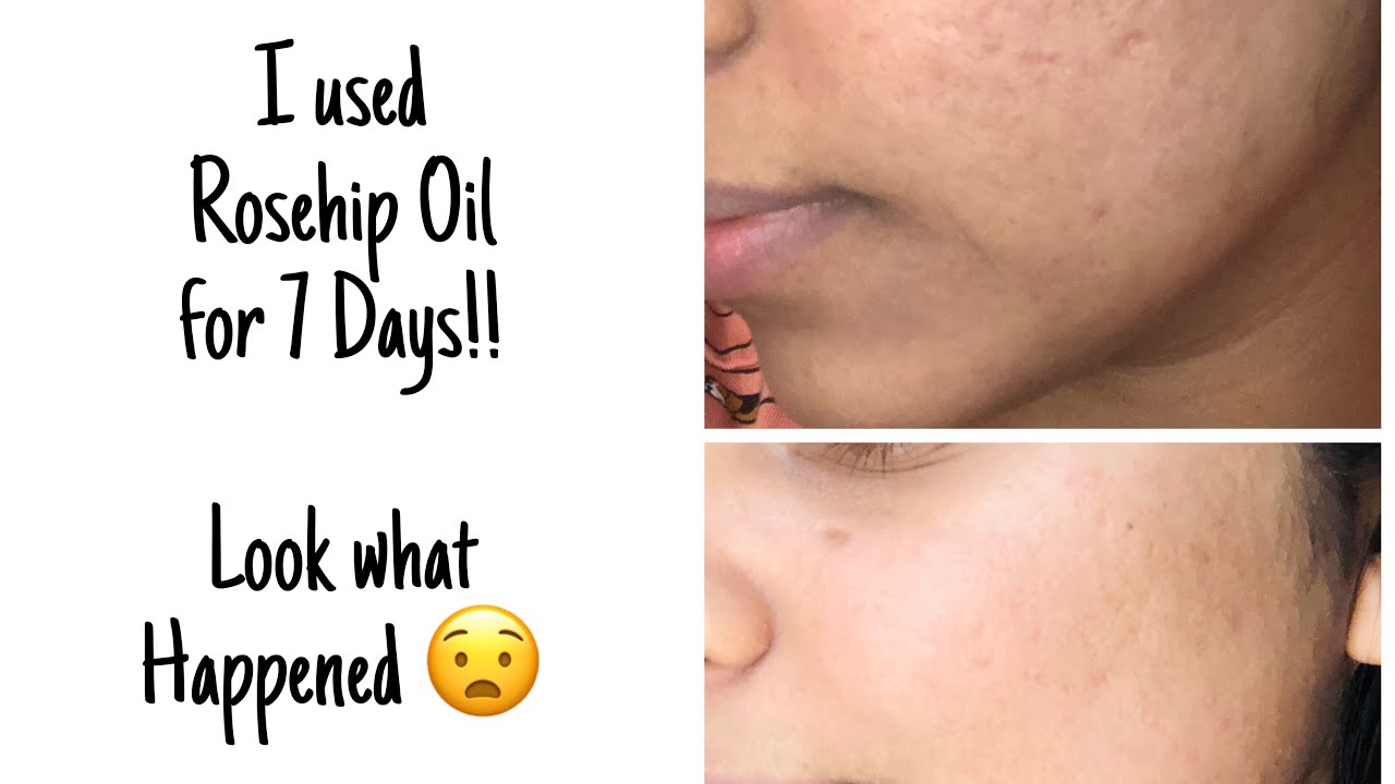 I used Rosehip Oil for 7 Days😧 YouTube
