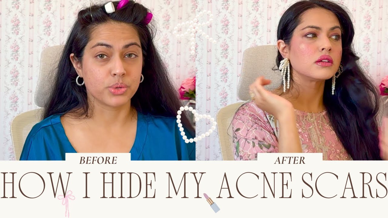 ACNE SCARS ARE NORMAL — BUT Here's How I Cover Mine Without HIDING who I am 🩷