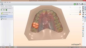 Digital Trans-palatal Appliance Design