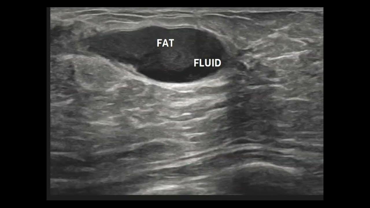 differentiating-breast-abscess-and-galactocele-on-ultrasound-with