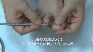 巻き爪予防；爪の切り方と再発予防策は？―大木皮膚科/病院・東京―