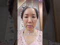 50代女性切開リフト手術リアルレビュー
