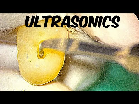 Ultrasonic Tips Improve Your Endo Skills