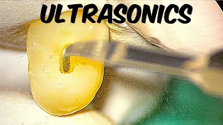 Ultrasonic Tips - Improve Your Endo Skills