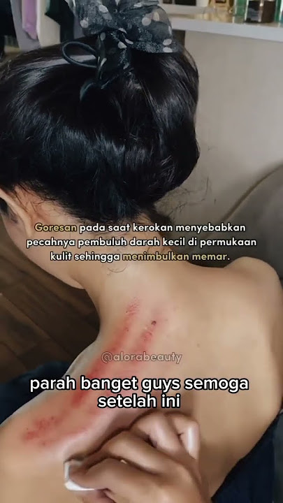 Kerokan wanita #pijat #kerokan #kerokanwanita #kerokanmasukangin