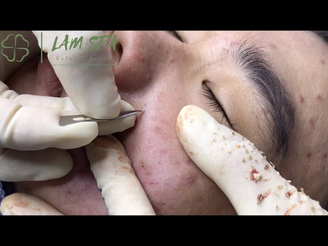 Inflamed Acne Treatment | 1901 | Nặn mụn viêm | LAM SPA