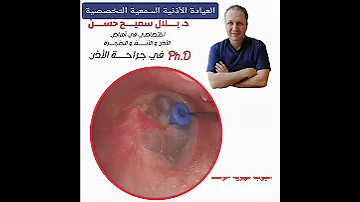 أنبوب التهوية المؤقت و يوضع في الاذن الوسطى بعد سحب السائل المصلي يبقى بين ٦ ٩اشهر و يخرج تلقائيا 