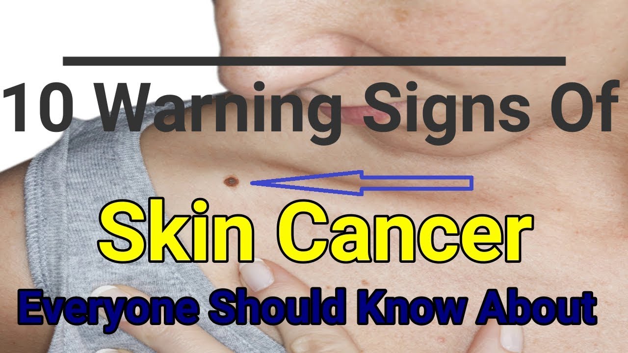 10 Warning Signs Of Skin Cancer Everyone Should Know About Youtube 