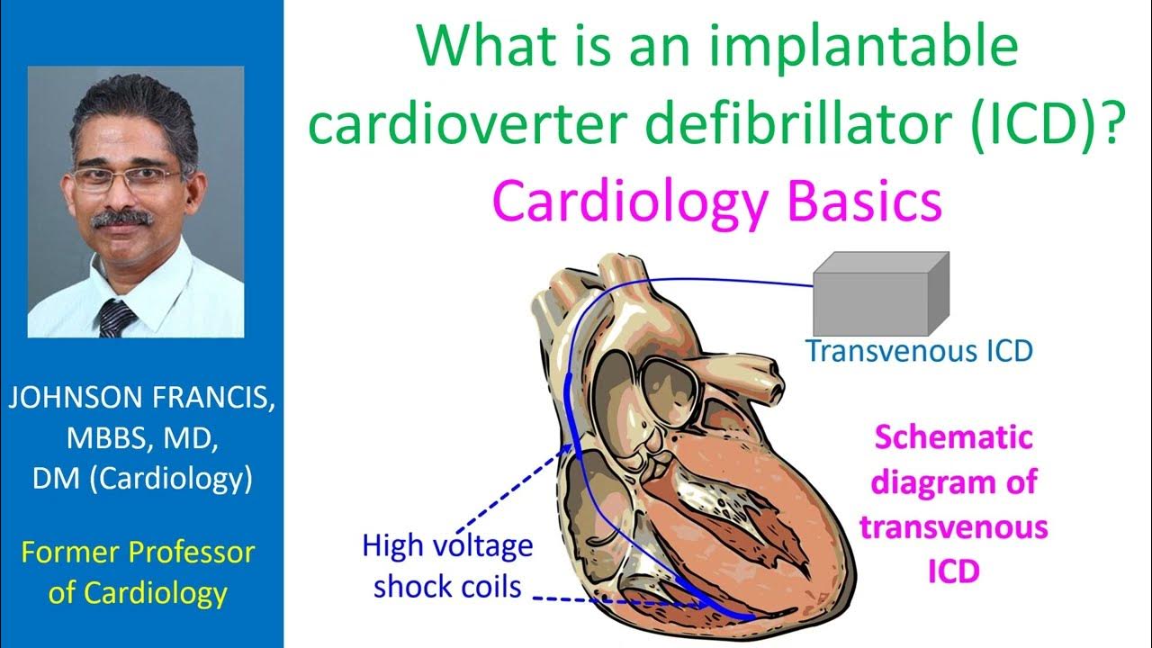 What is an implantable cardioverter defibrillator (ICD)? Cardiology