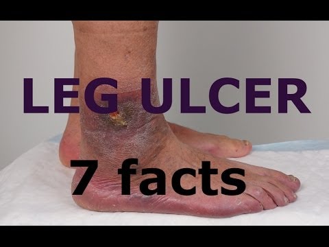 Varicose ulcer | definition of varicose ulcer by Medical ...