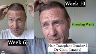 Hair Transplant #2 Week 10 now COVID. How's it growing? Dr Cinik, Istanbul