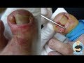 EXTREME INFECTED INGROWN TOENAIL REMOVAL OF DEFORMED TOENAIL SURGERY