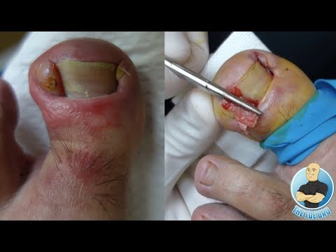 Video: Indgroet Toenail-infektion: Symptomer Og Behandlinger