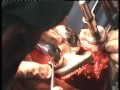 Intraop cementing and implantation in total knee replacement
