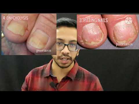 NAIL ABNORMALITIES | CLINICAL | CLUBBING | KOILONYCHIA | MEES LINES | PITTING | ONYCHOLYSIS